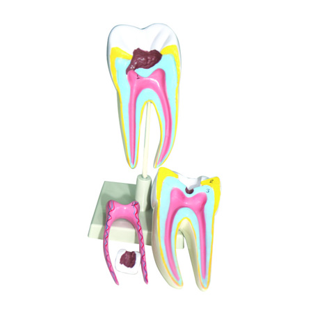 MOLAR WITH DENTAL CARIES 6 Parts